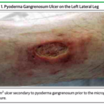 Epidermal Grafting in Pyoderma Gangrenosum – JAMA Derm
