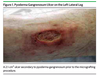 Epidermal Grafting in Pyoderma Gangrenosum – JAMA Derm