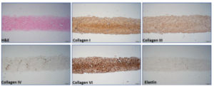 An aseptically processed, acellular, reticular, allogenic human dermis follow-up study