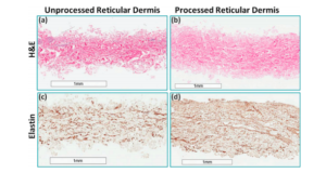 Acellular reticular allogenic human dermis vs SOC in DFU