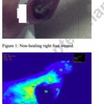 Fluorescence Angiography in Lower Extremity Ulcers in Patients with Peripheral Arterial Disease