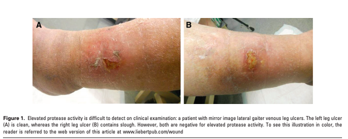 Development of a Novel Technique to Collect Proteases from Chronic Wounds