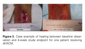 A multicenter, randomized, controlled clinical trial evaluting the use of dehydrated human amnion and multilayer compression therapy in treatment of VLU